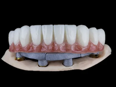 weonelab_bar_all_on_four_dentures_3-1.webp