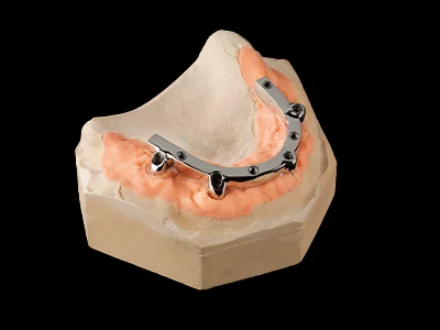 weonelab_bar_all_on_four_dentures_m.webp