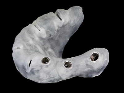 weonelab_dental_surgical_guide.webp