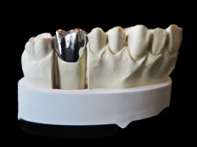 weonelab_metal_fullkron_fixed_prothesis.webp