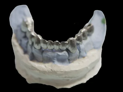 weonelab_metal_fullkron_fixed_prothesis_1.webp
