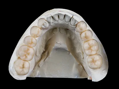 weonelab_porcelain_fixed_prothesis.webp