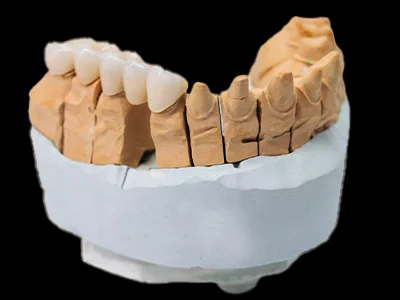 weonelab_porcelain_fixed_prothesis_1.webp