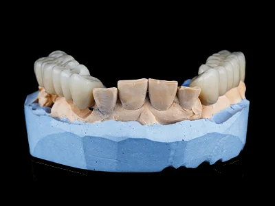 weonelab_porcelain_fixed_prothesis_3.webp