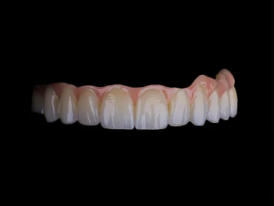 weonelab_porcelain_on_implant_fixed_prothesis.webp