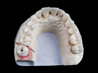weonelab_porcelain_on_implant_fixed_prothesis_1.webp